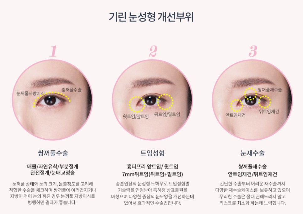 요즘 누가 티나게 성형하니? 기린성형외과 자연유착으로 미모완성♥(+후기) 관련 이미지 5