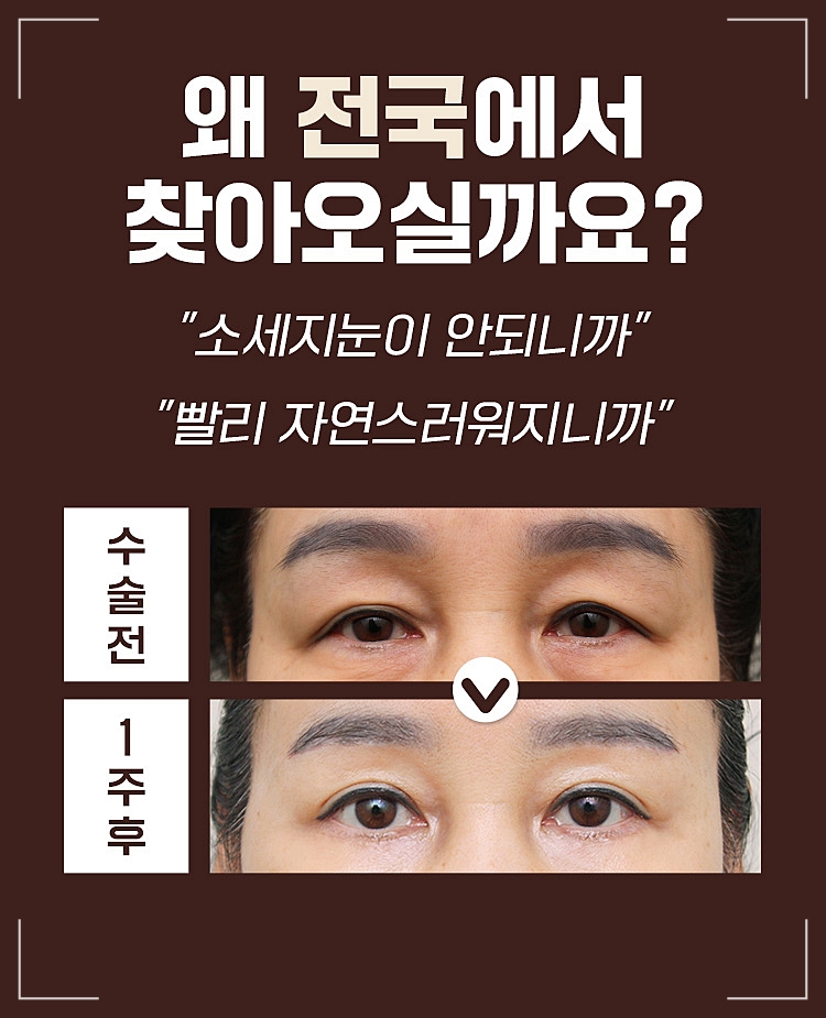 중년눈성형 처진 눈매교정 젊음의 시작 관련 이미지 3