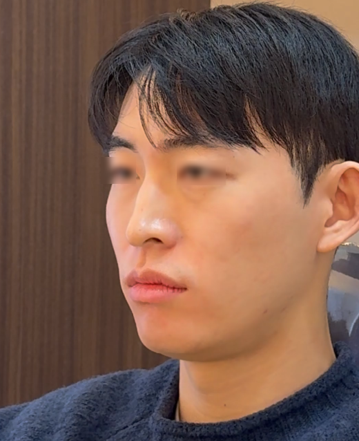 남자 미니젤리코 사례로 보는 코시술 후기 관련 이미지 2