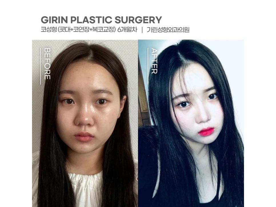 복코수술후기 제대로 찾아야 하는 이유는 관련 이미지 12