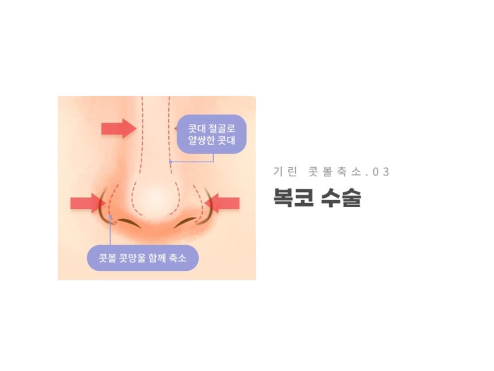 콧볼축소수술전후 얼마나 달라질까 관련 이미지 6