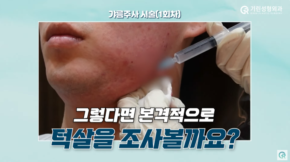 [기린성형외과의원] 수술 없이 턱라인 개선하기_인모드와 지방분해주사 관련 이미지 8