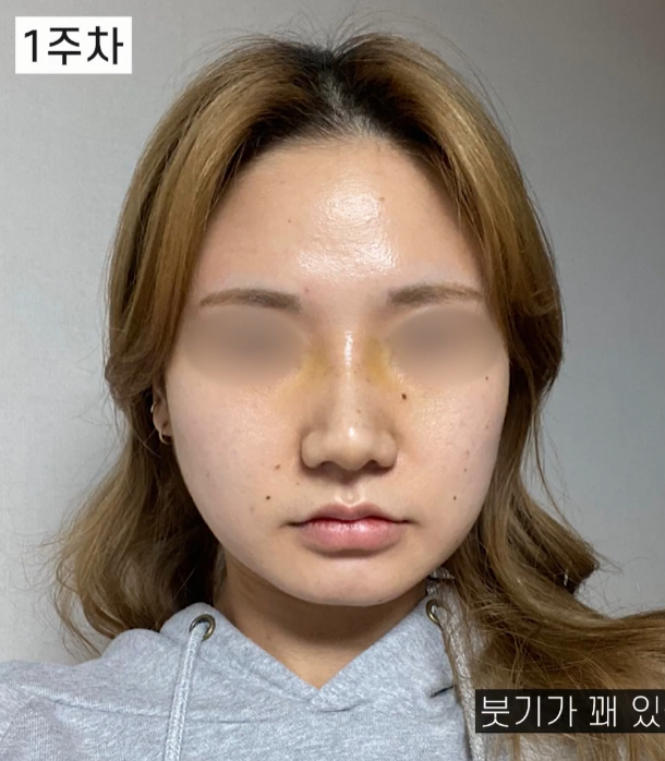 [기린성형외과의원] 코끝과 콧볼 교정으로 얄쌍해진 코_복코성형 수술일지 관련 이미지 3