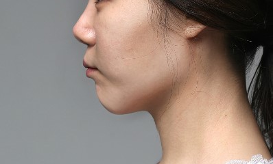 티절골만이 턱끝수술의 답일까? 관련 이미지 6