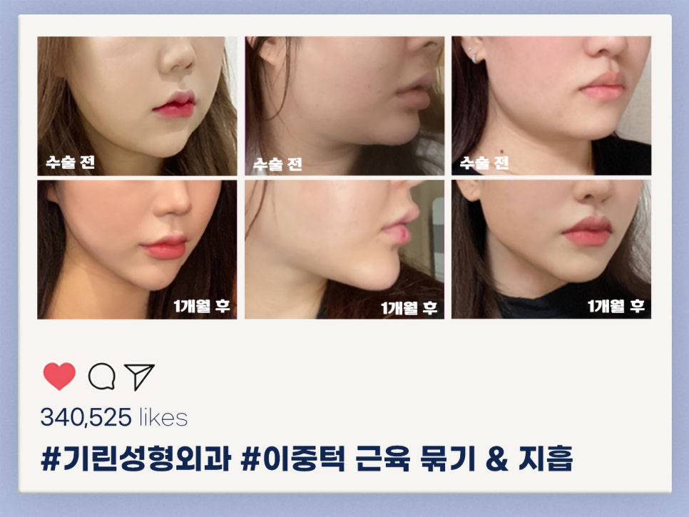 이중턱지흡 생각한다면 관련 이미지 3