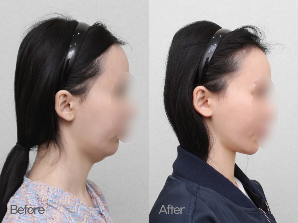 이중턱성형 차이가 궁금하다면 관련 이미지 1