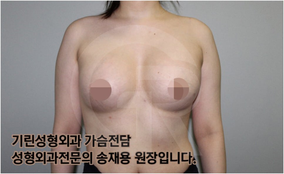 가슴확대수술 후 관리방법, 실제사례 알아보다. [기린성형외과의원_Dr.송재용] 관련 이미지 11