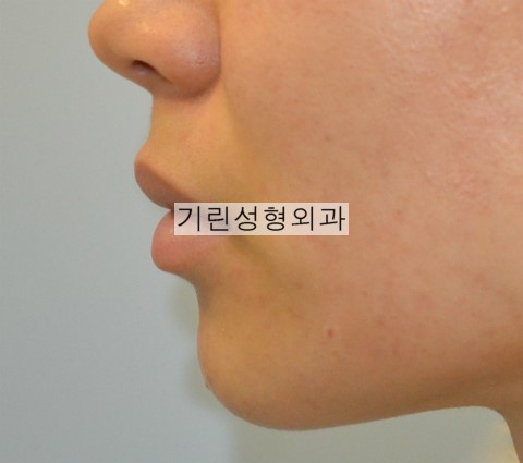 절골을 통한 무턱수술 전후 비교 관련 이미지 2