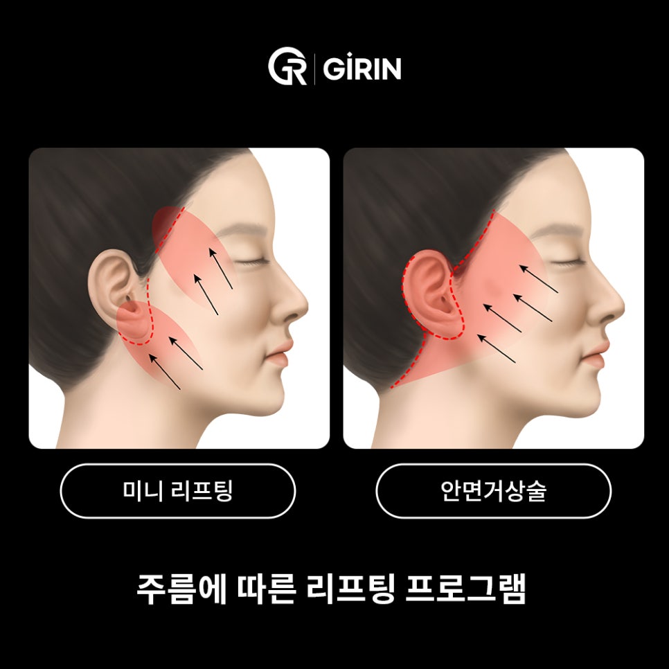 안면거상 비용, 왜 이렇게 차이 날까? 관련 이미지 3