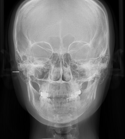 안면비대칭인경우에 윤곽수술로 개선가능성. 관련 이미지 2