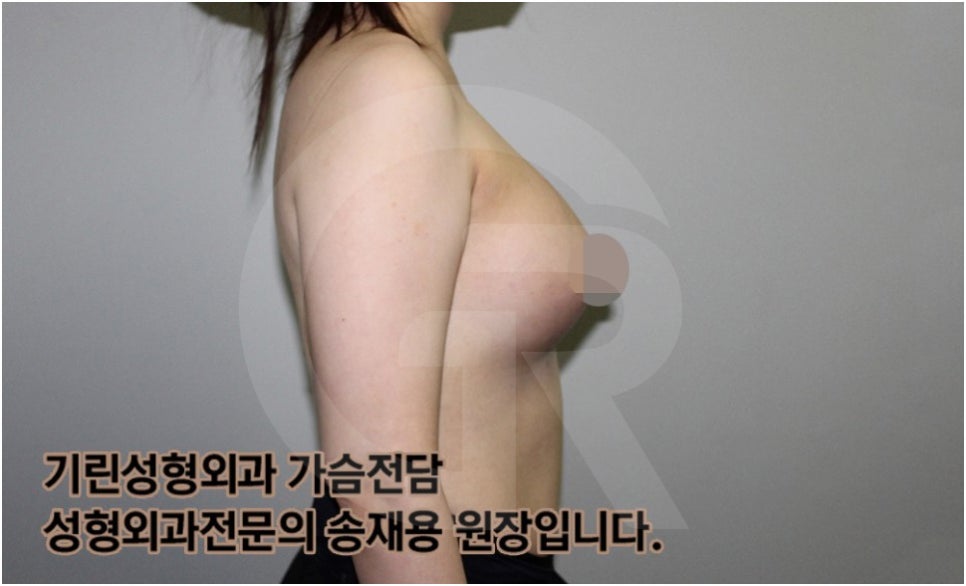 가슴확대수술 후 관리방법, 실제사례 알아보다. [기린성형외과의원_Dr.송재용] 관련 이미지 13