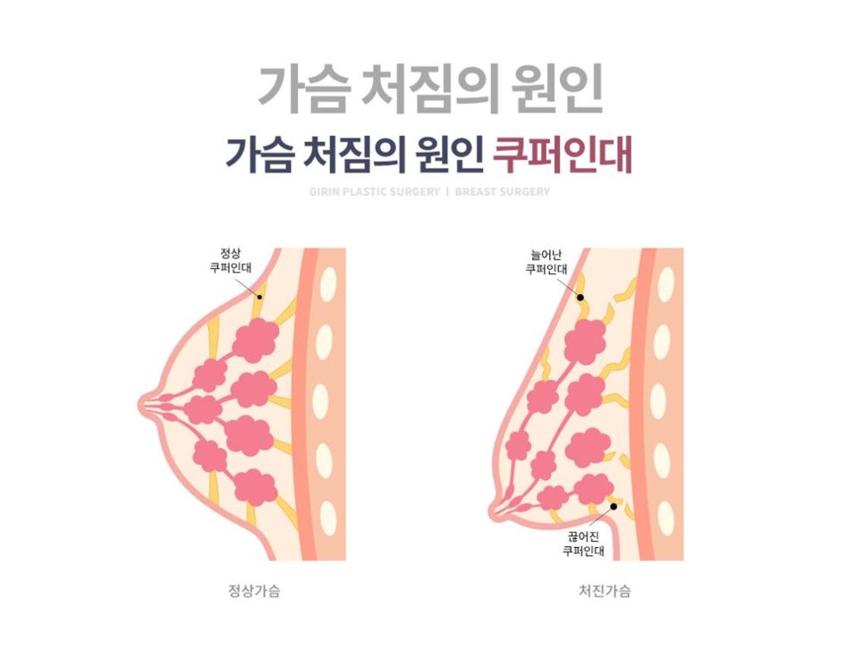 처진가슴성형 자신감 회복을 위해 관련 이미지 2