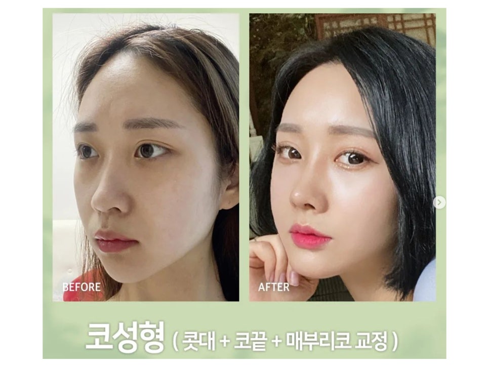 논현성형외과 낮은 콧대 고민은 관련 이미지 3