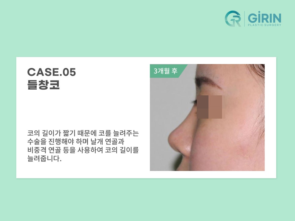 코성형 종류 비교하고 맞춰서 관련 이미지 14