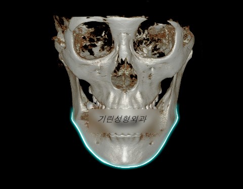 긴턱 사각턱수술 : 앞턱이 긴 경우 관련 이미지 1
