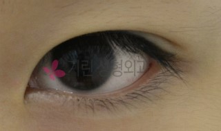 쌍꺼풀아웃라인도 비절개눈매교정으로 관련 이미지 1