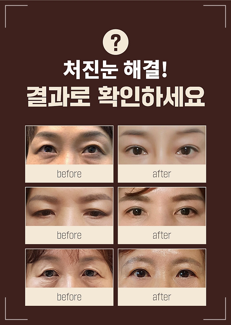 중년눈성형 처진 눈매교정 젊음의 시작 관련 이미지 2