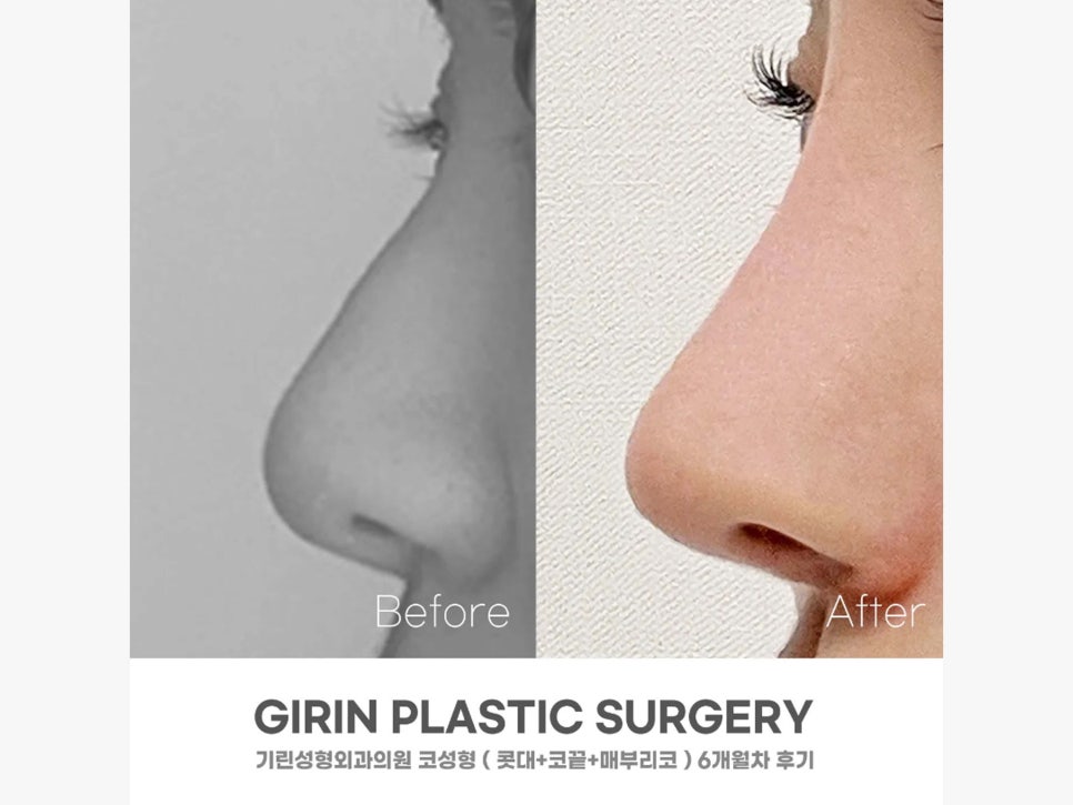 매부리코수술후기 올바른 라인으로 관련 이미지 3