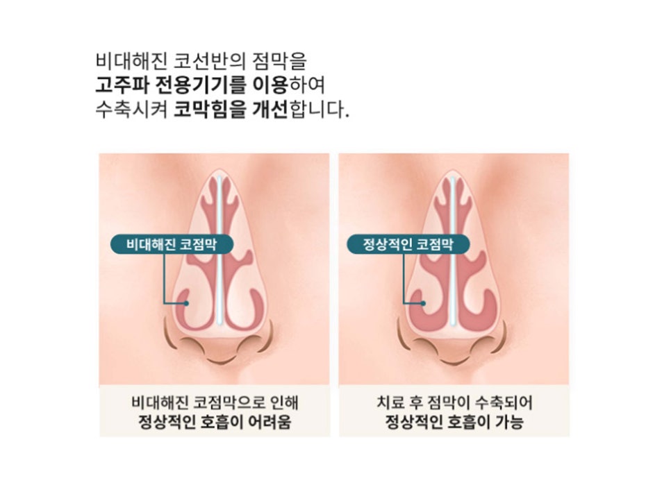 강남기능코성형 원인과 필요성 생각하여 관련 이미지 7