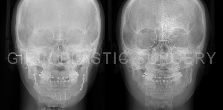 양악수술후 이차각, 라인불균형으로 인한 재수술 관련 이미지 4