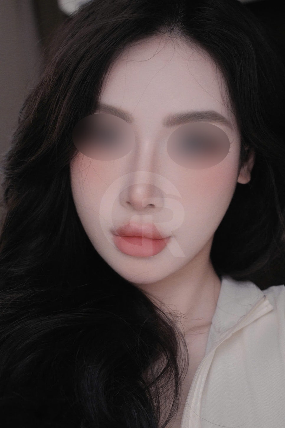연조직윤곽술, 비대칭을 최소화하는 방법 관련 이미지 7