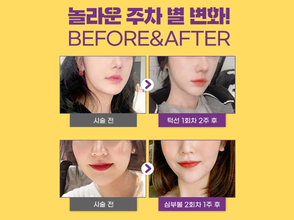 강남윤곽주사 스테로이드 선택도 가능해 관련 이미지 12