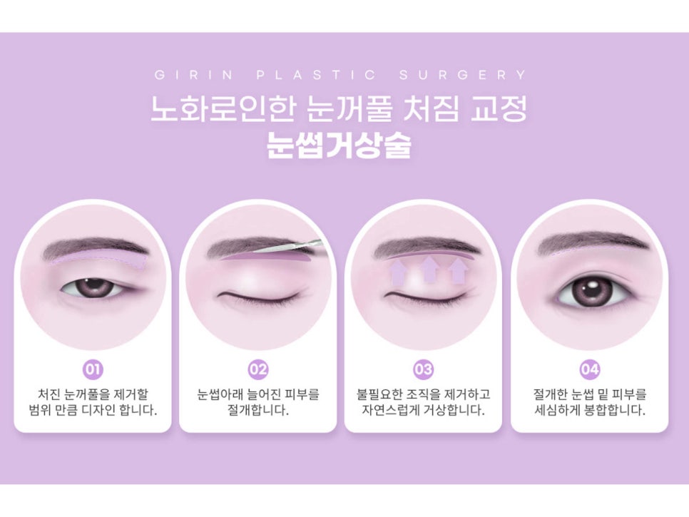 상안검수술회복기간 확인하자 관련 이미지 9