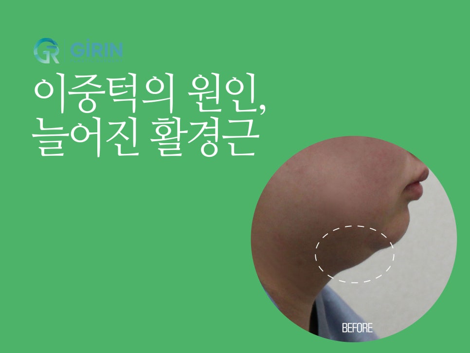이중턱수술 확실히 효과 보려면 관련 이미지 2