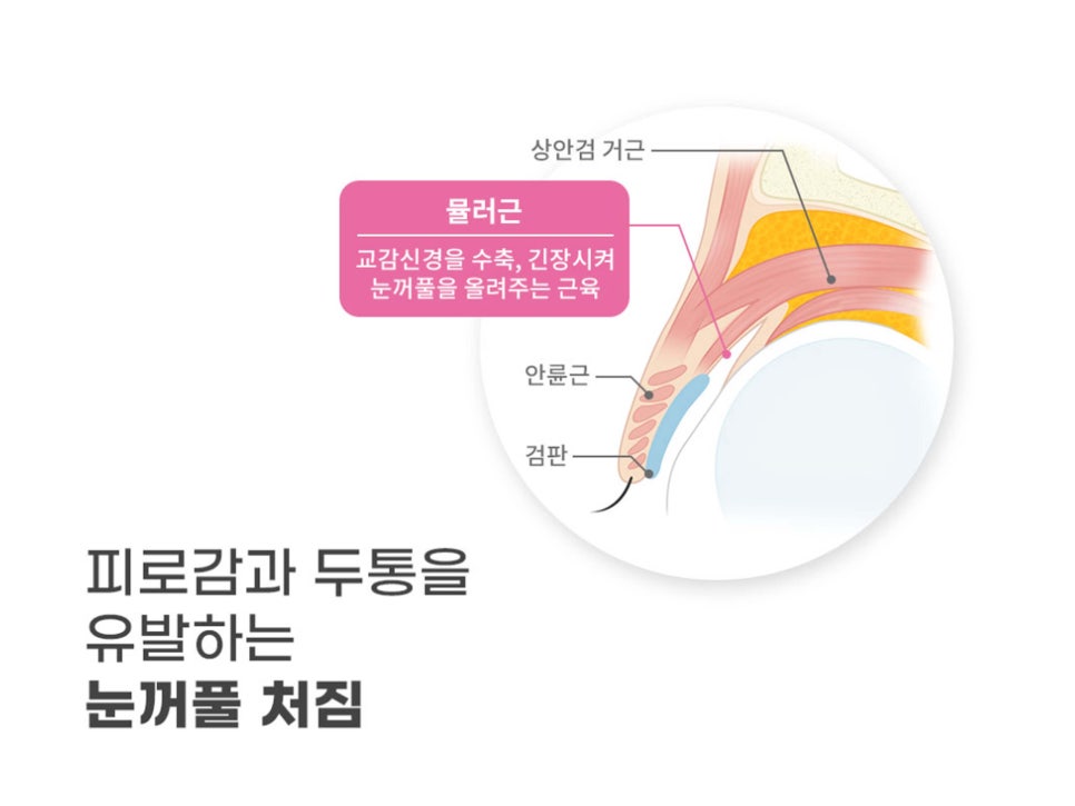상안검수술회복기간 확인하자 관련 이미지 8