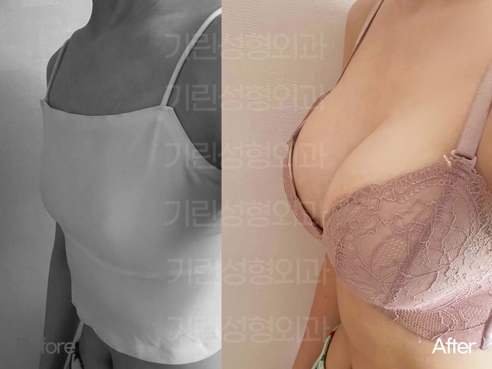 강남가슴수술 촉감과 라인도 중요하니까 관련 이미지 3