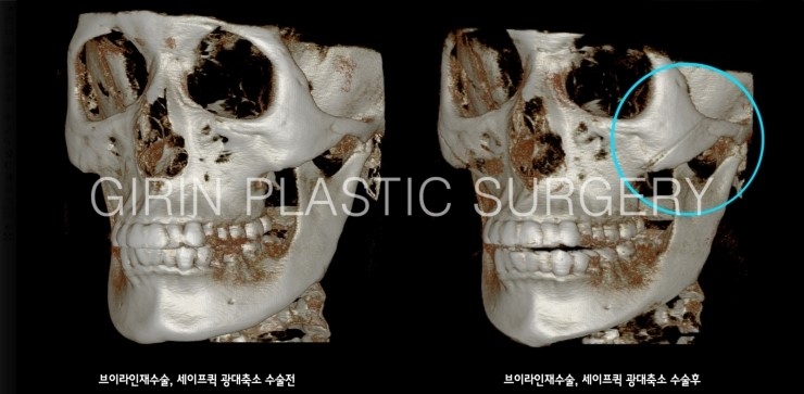 귀뒤사각턱 재수술사례 관련 이미지 2