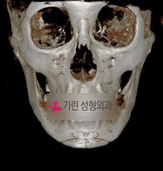안면윤곽수술의 대표적인 사각턱과 앞턱(엑스레이사진) 관련 이미지 4