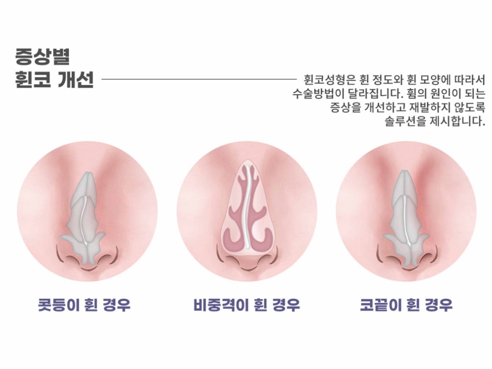 강남역성형외과유명한곳 얼굴에 맞춰 조화롭게 관련 이미지 14