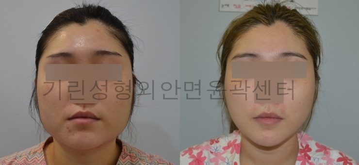 긴곡선+아큐스컬프+귀족수술 7게월 경과 관련 이미지 1