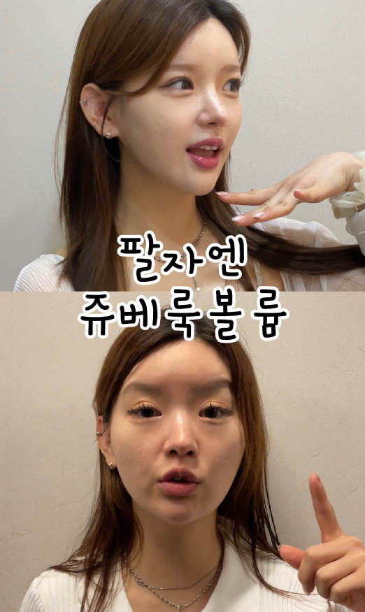 기린성형외과 쥬베룩볼륨 팔자주름, 앞볼, 관자 후기 관련 이미지 1