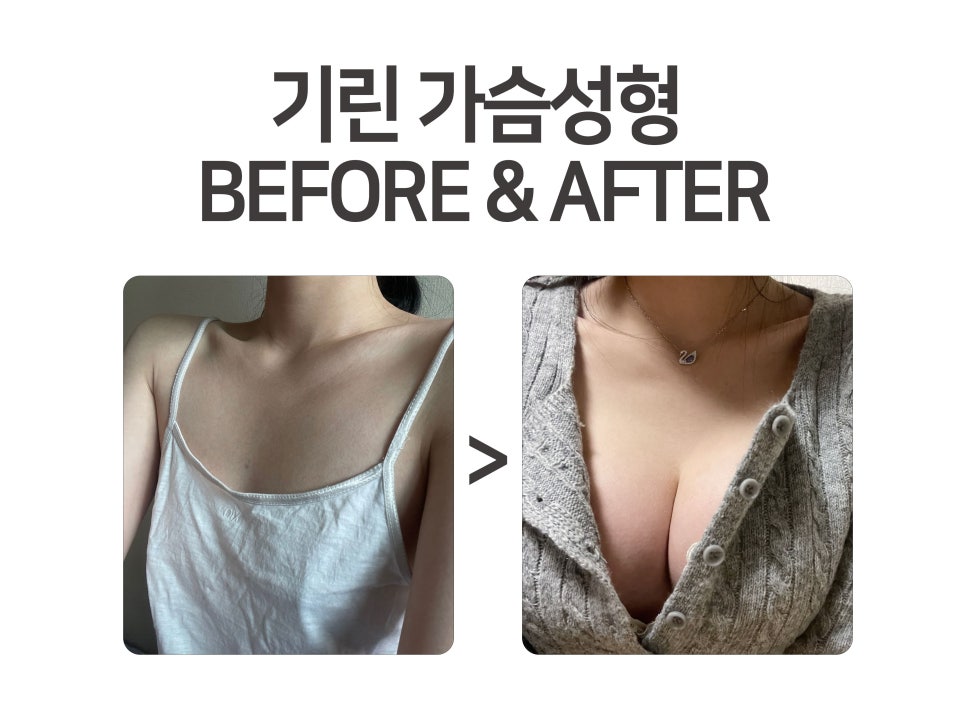 가슴성형종류 알고 선택해야 관련 이미지 3