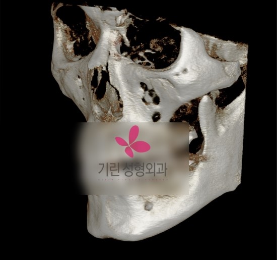 앞턱수술의 효과 관련 이미지 1