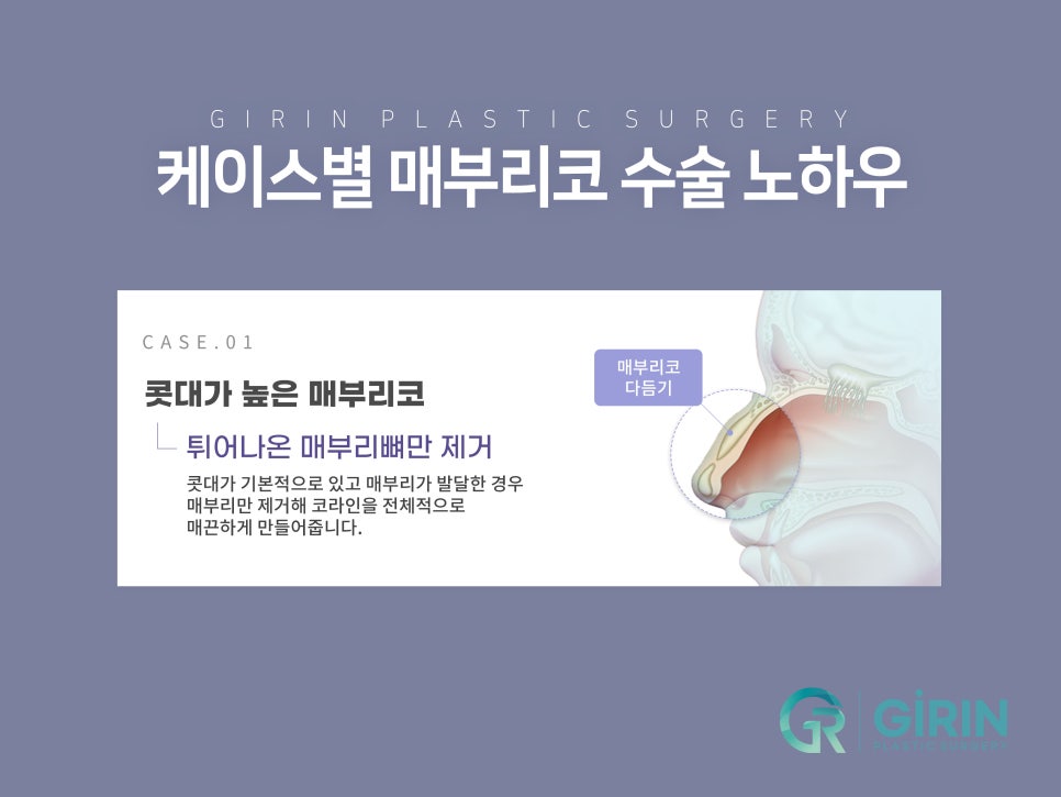 매부리코수술후기 방법까지 확인해 관련 이미지 9