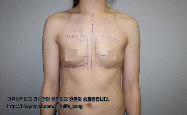 [가슴확대성형] 75A에서 75C로, 모티바 보형물을 이용한 가슴 확대 수술 케이스 관련 이미지 4