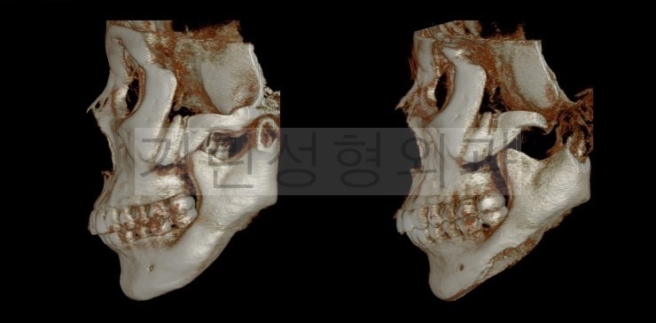 [효과미비 재수술사례] 이차각제거 및 브이라인재수술 관련 이미지 5