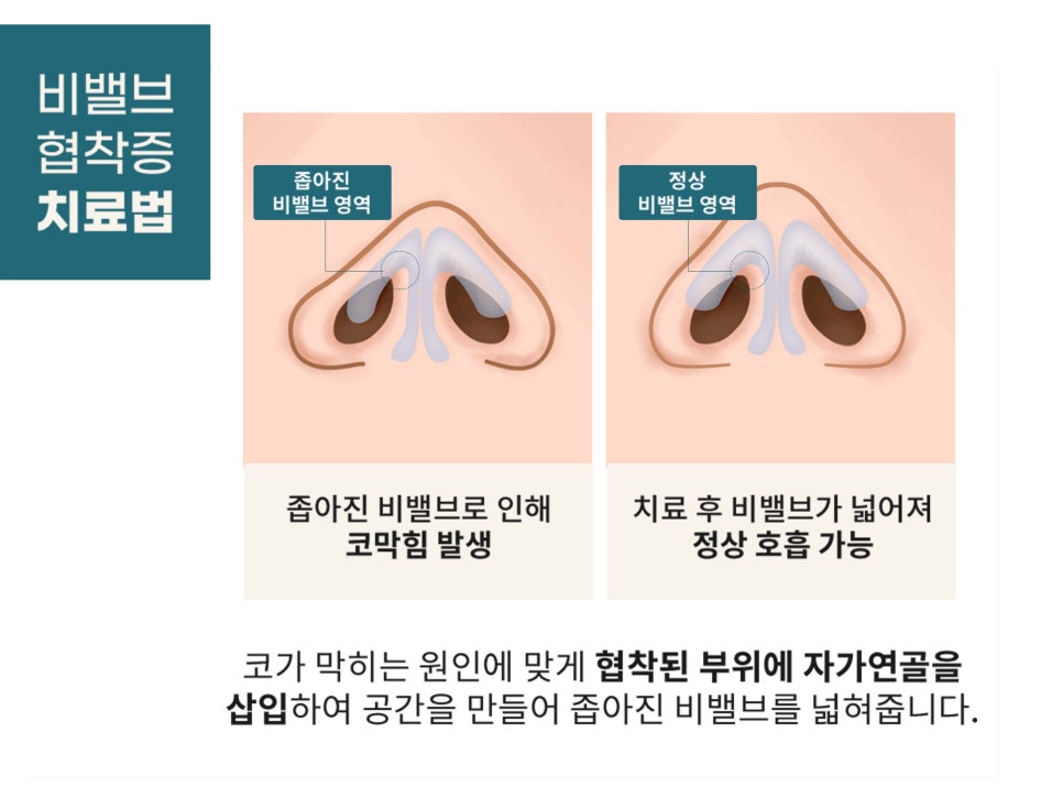 기능코수술 불편함을 해결하자 관련 이미지 11
