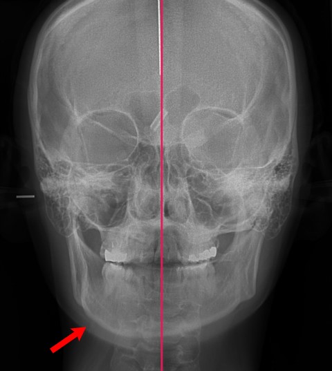 안면비대칭인경우에 윤곽수술로 개선가능성. 관련 이미지 1