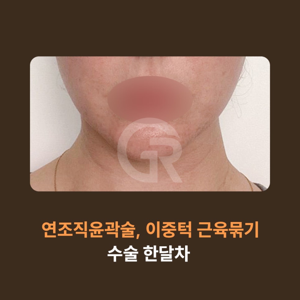 다이어트 후 이중턱은 그대로, 얼굴처짐만 심해졌을 때 해결 방안 관련 이미지 8