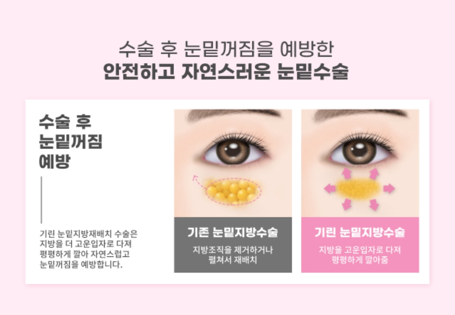 눈밑지방제거수술 하안검 선택의 폭이 넓어졌어요! 관련 이미지 3