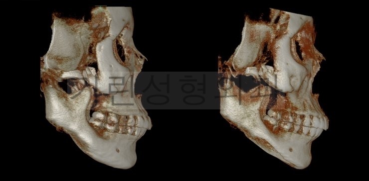 [효과미비 재수술사례] 이차각제거 및 브이라인재수술 관련 이미지 3