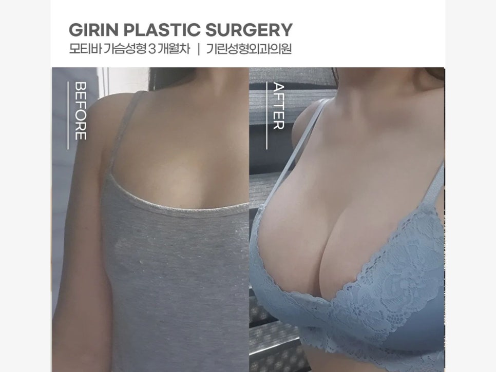 가슴수술잘하는곳 과정도 확인하며 관련 이미지 10