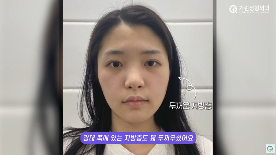 [기린성형외과의원] ❌보정어플은 당장 삭제❌_윤곽3종 수술일지 관련 이미지 6