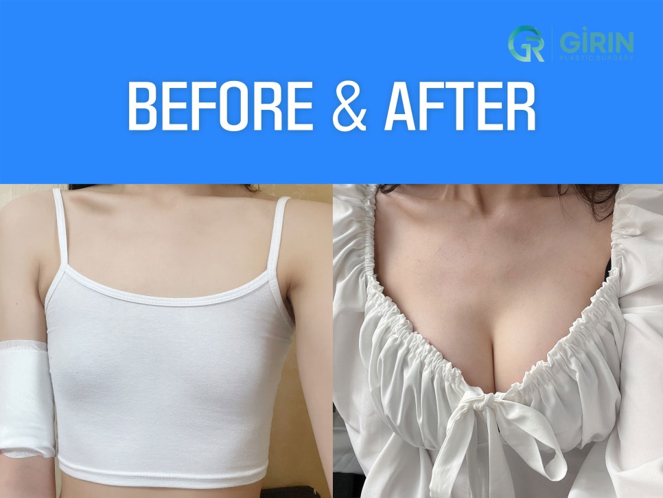 유방확대술 고려하고 있다면 관련 이미지 3