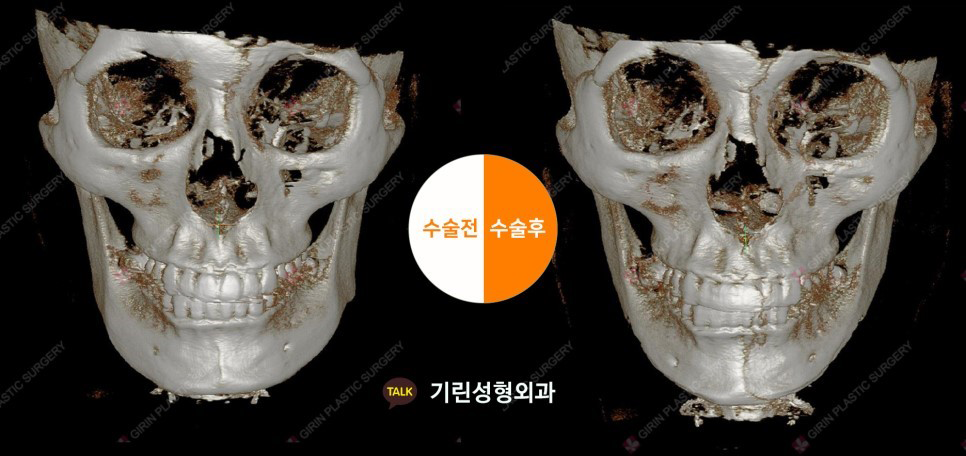 [뉴브이라인]45도 라운딩 브이라인 절골술로 작은 얼굴 만들기 관련 이미지 9