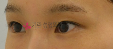 매몰법과 비절개눈매교정의 차이 관련 이미지 1